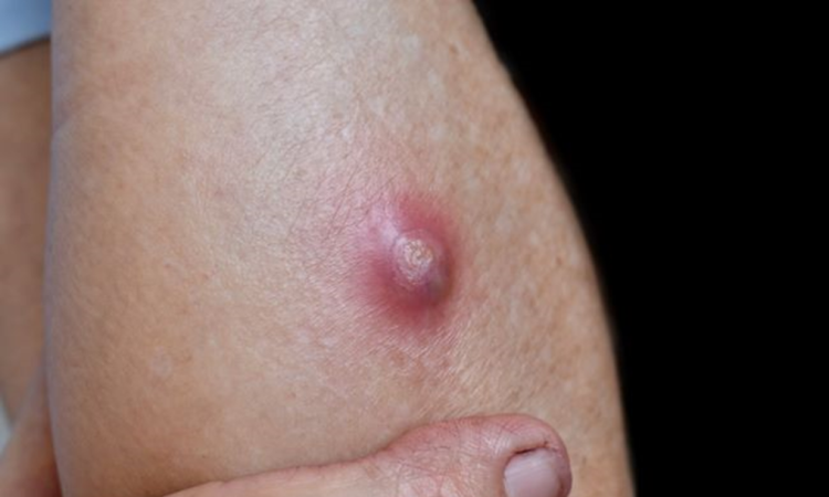 4 Jenis Bisul yang Membahayakan Tubuh dan Cara Pengobatannya