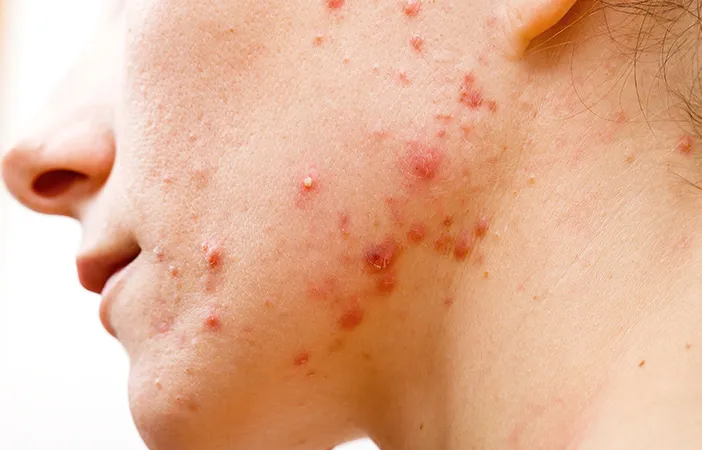 6 Cara Hilangkan Jerawat Batu Secara Alami dalam 1 Hari