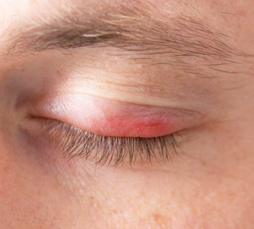 4 Penyebab Radang Kelopak Mata