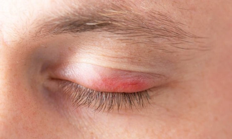 4 Penyebab Radang Kelopak Mata