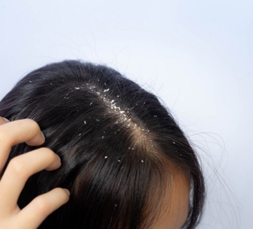 4 Cara Mengatasi Ketombe yang Ampuh