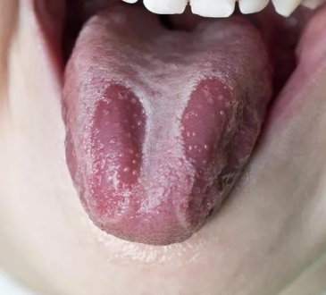 Ciri-ciri Lidah Berjamur yang Harus Anda Waspadai