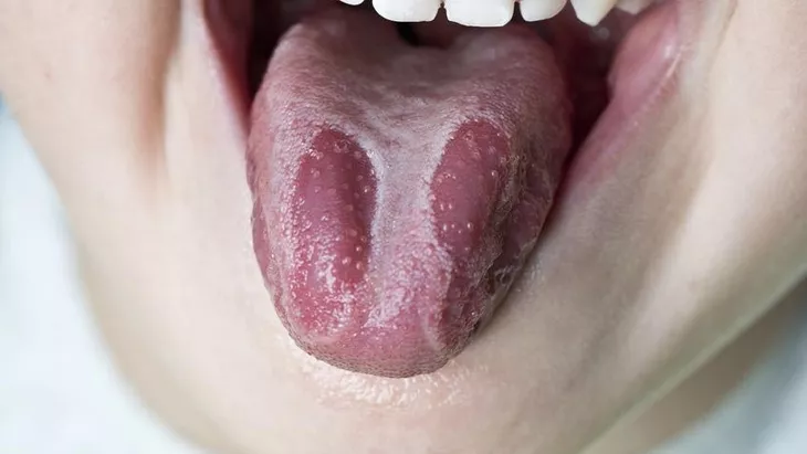 Ciri-ciri Lidah Berjamur yang Harus Anda Waspadai