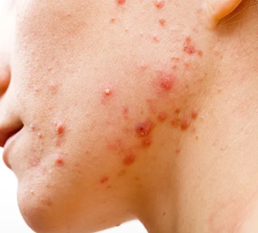 6 Cara Hilangkan Jerawat Batu Secara Alami dalam 1 Hari