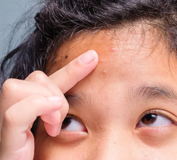 8 Cara Menghilangkan Bruntusan di Jidat yang Bikin Minder