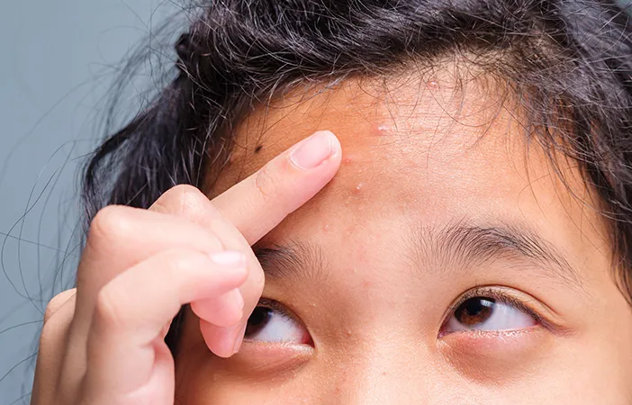 8 Cara Menghilangkan Bruntusan di Jidat yang Bikin Minder