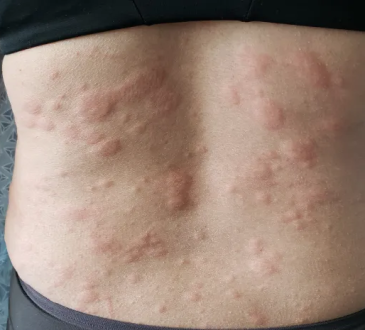 Begini Cara Mengatasi Biduran pada Ibu Menyusui