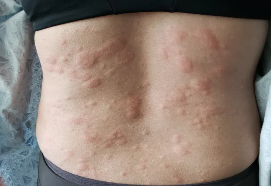 Begini Cara Mengatasi Biduran pada Ibu Menyusui