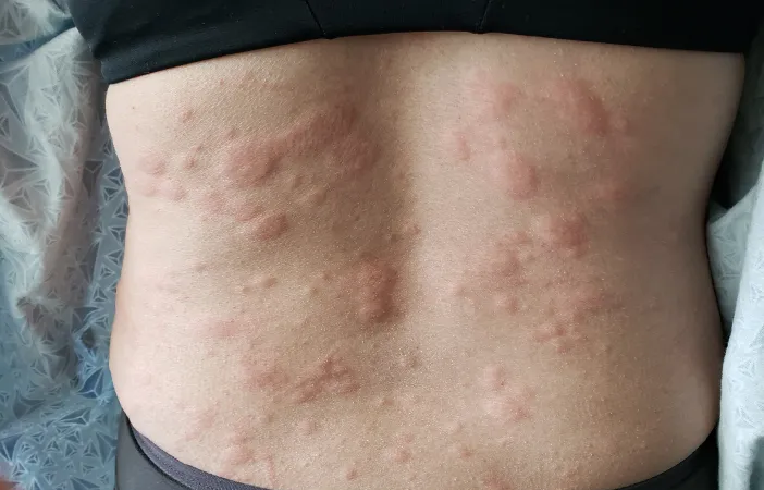 Begini Cara Mengatasi Biduran pada Ibu Menyusui