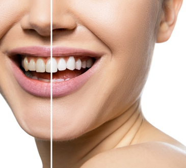 Begini Cara Memutihkan Gigi yang Kuning