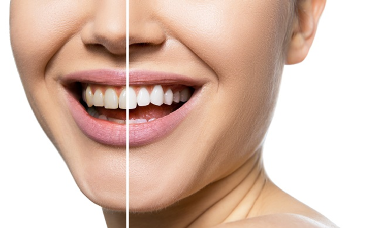 Begini Cara Memutihkan Gigi yang Kuning